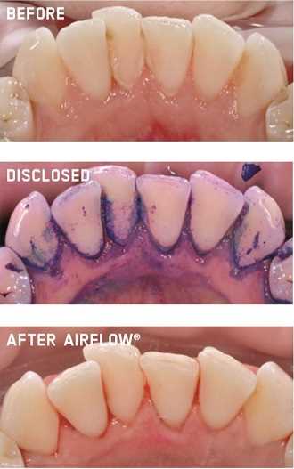 Airflow Tooth Polishing: Everything You Need to Know