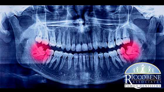 Common Problems with Wisdom Teeth: All You Need to Know