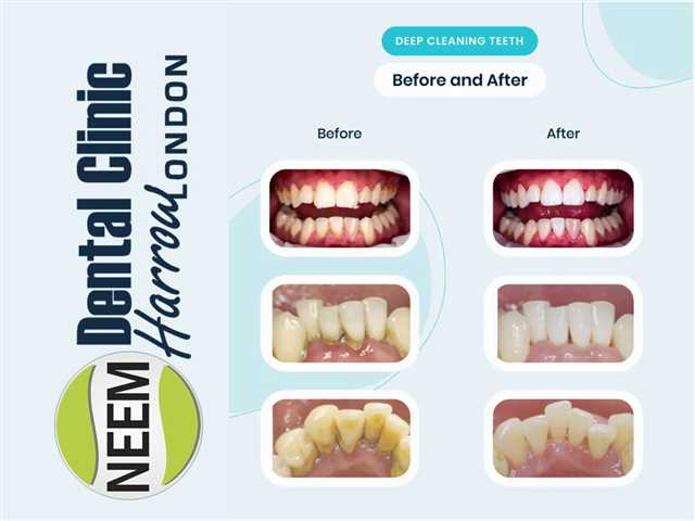 How much does deep cleaning teeth cost?