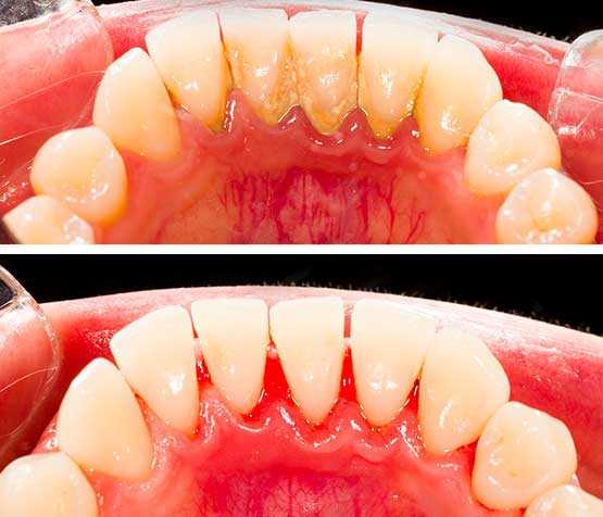 Deep cleaning teeth before and after