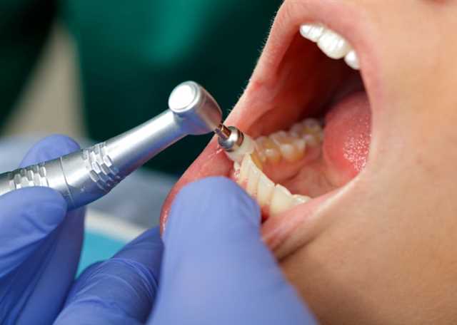 Prevention of Dental Disease